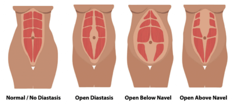 Rectus Diastasis (Abdominal Separation) - Peak Physio